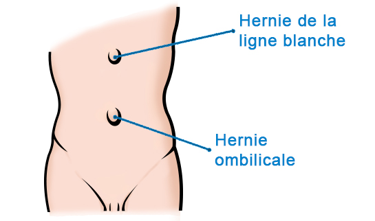 Centre de Chirurgie Viscérale - Hernies abdominales et éventrations
